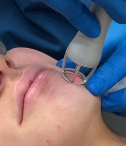 Types of acne scars — ice pick, boxcar and rolling scars explained